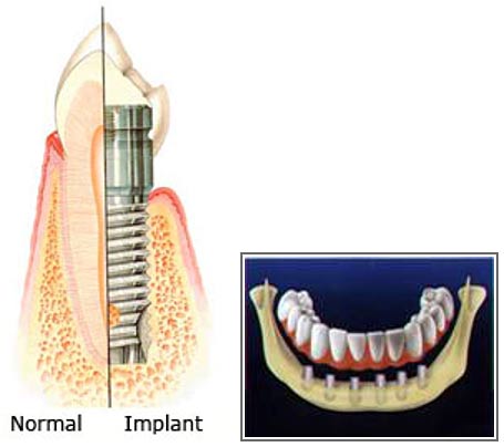 Dental implant