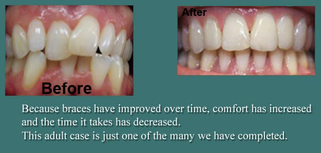 Before and After Orthodontics