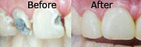 Dental Restoration